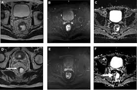 In a person with colorectal cancer, a ct scan can check for the spread of cancer to the lungs, liver, and other organs. Imaging Of Colorectal Cancer The Clue To Individualized Treatment