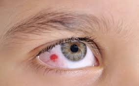 Hallo nochmal, mein lebensgefährte hat in den letzten wochen oft geplatzte adern in den augen. Rote Augen Gerotete Augen Ursachen Therapie Onmeda De
