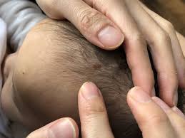 As of right now, fewer than one. Weird Mole On Baby S Head Scared It S Melanoma Babycenter