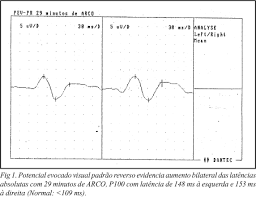 Levantar por sí misma, y la trasladan a una clínica donde le hacen el terrible diagnóstico: Scielo Brasil Sindrome De Miller Fisher E Neurite Optica Relato De Caso Sindrome De Miller Fisher E Neurite Optica Relato De Caso