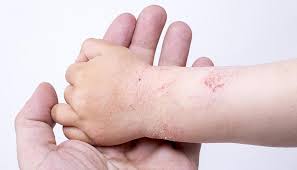 Image result for dermatitis contacta toxica