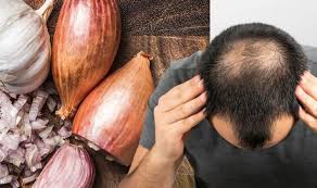 The most important part of any hair loss treatment plan is to determine the cause of hair loss. Hair Loss Treatment Garlic Extract An Efficient And Rapid Treatment For Alopecia Daily Star Post