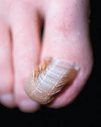 Image result for Onychogryphosis feet