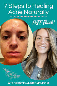 Pin On Healing Acne Naturally Post Birth Control Acne
