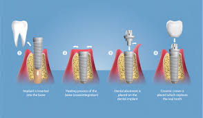 Image result for dental implant