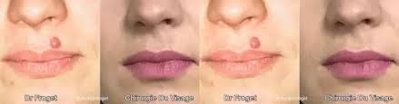 Sur le visage, je sais pas, mais maman en avait un sur le dos, juste au niveau du soutif, et il a été enlevé chez le dermato, en anesthésie locale. Enlever Un Grain De Beaute Au Laser Estheticon Fr