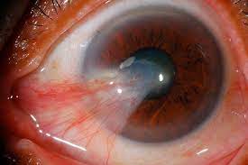 Carnosidad En Los Ojos Pterigion Causas Sintomas Y Tratamientos