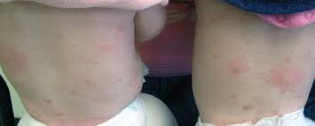 Image result for Urticaria pigmentosa children