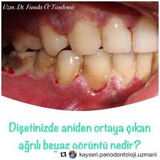 Nekrotizan Gingivitis Hastaliklar Tedavisi 0 5 Hidrojen Peroksit Veya 0 1 Klorheksidin