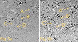 Blood cells in isotonic solutions do not shrink or swell. Evidence That Asymmetry Of The Membrane Cytoskeletal Complex In Human Red Blood Cell Ghosts Is Responsible For Their Biconcave Shape Pnas