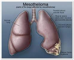 Mesothelioma is a cancer of the mesothelial cells that line a number of internal organs. Smoking Can Increase Risks Caused By Asbestos Exposure Framework Convention Alliance
