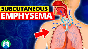 Image result for Emphysema