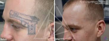 After two treatments, the tattoo was almost completely gone! Non Profit Laser Tattoo Removal Erasing Memories Of The Past