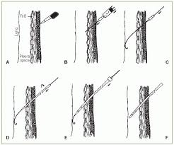 Image result for Small Caliber Chest Tube