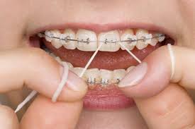 Be careful not to damage the wires. The Importance Of Flossing While In Braces Dischinger Orthodontics