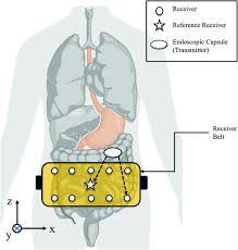 Image result for Wireless Capsule Endoscopy