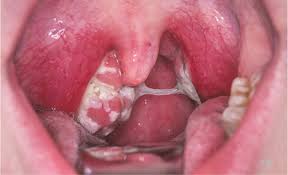 Image result for Peritonsillar Abscess