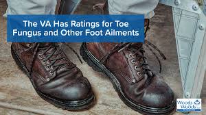 How Toe Fungus And Other Foot Pain Earn Va Disability Ratings