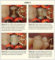 We did not find results for: Material Options For Class Ii Composite Restorations Varied Clinical Parameters Require Different Techniques Dentistry Today