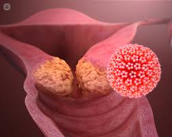 There are about 100 types of hpv that how do you get human papilloma virus (hpv)? Human Papillomavirus Hpv What Is It Symptoms Causes Prevention And Treatment Top Doctors