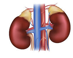 Image result for Hyperaldosteronism