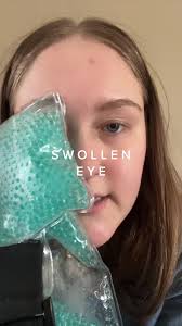 Lol help what do I do #swolleneye #scratchedcornea #eyeinjury #eyealle...