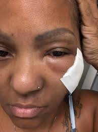 Has anyone experienced temporary vision loss due to TIA with CREST syndrome?