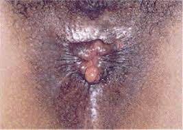 Check spelling or type a new query. Hemorrhoids What The Dermatologist Should Know Sciencedirect