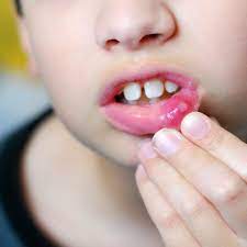 Find the perfect toddler mouth stock photos and editorial news pictures from getty images. What To Do About Your Kid S Cold Sore Junior Smiles Children S Dentistry