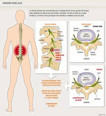 Functional constipation is diagnosed when no secondary causes can be identified, such as a medical condition or a medicine with a side effect profile that includes constipation. Neuf Hernies Discales Sur Dix Se Soignent Sans Chirurgie Planete Sante