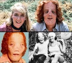 The True Story of Roy Lee 'Rocky' Dennis and the Film 'Mask'