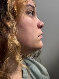 How to reduce double chin?