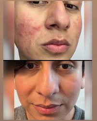 DeAnna Miranda/Esthetician/Acne specialists (@skinguru.la) • Instagram  photos and videos