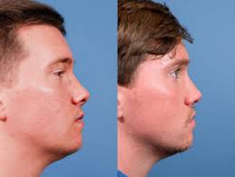 Dr Cochran in Dallas, Texas 75231 » Rhinoplasty: Cost, Pics, Reviews, Q&A