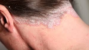 Loyon Soll Im Kampf Gegen Die Schuppen Helfen Kopf Und Gesicht Psoriasis Netz