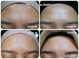 Produk ini merupakan seri dari avoskin miraculous refining series yang fokusnya untuk mengangkat sel kulit mati & mencerahkan wajah. Avoskin Miraculous Refining Toner Review Setelah Pemakaian 1 Bulan Dini The Stories