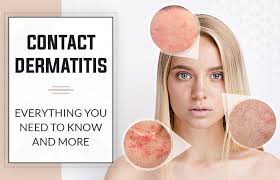 Image result for contact dermatitis