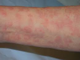 Maybe you would like to learn more about one of these? Sekundaer Syfilis Arsager Symptomer Diagnose Og Behandling Hvor Er Det Bedste Sted At Blive Testet For Syfilis