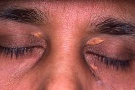 Image result for xanthelasma of eyelid