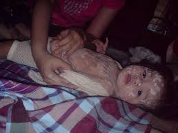 Demam campak apk version 1.0 download for android devices. Demam Campak