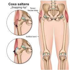 Snapping Hip Syndrome Orthopedic Hip Specialist Manhattan New York City Ny