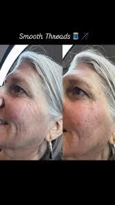 Smooth PDO threads are an effective, minimally invasive treatment for  periorbital fine lines. By stimulating collagen production, they help  improve skin elasticity and reduce the appearance of crow’s ...