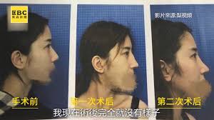 悔不當初！天然美女整容失敗花44萬卻整成「蛇精臉」｜東森新聞