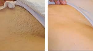 The process is called photothermolysis. Laser Hair Removal For Bikini Area Dubai Euromed Clinic