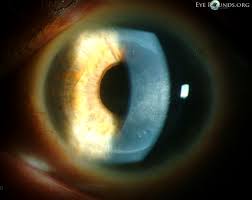 Hsv keratitis can be associate … Herpes Simplex Virus Hsv Geographic Epithelial Keratitis