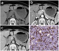 Ct if the cause of a distal bile duct obstruction is not revealed by us and there is a high suspicion for a pancreatic or periampullary tumor, the next diagnostic test is ct. Nonhypervascular Pancreatic Neuroendocrine Tumors Spectrum Of Mdct Imaging Findings And Differentiation From Pancreatic Ductal Adenocarcinoma European Journal Of Radiology