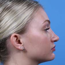 Rhinoplasty Before and After