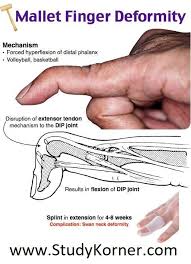 Jewel splint is creating medical accessories that are highly functional, but also beautiful. Swan Neck Deformity Mallet Finger Physical Therapy Studykorner Physical Therapy Medical Anatomy Hand Therapy