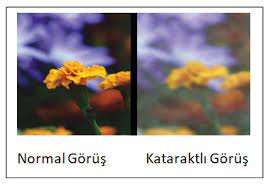 katarakt tedavisi prof dr gokhan gulkilik