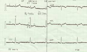 Read about the electrocardiogram (ecg, ekg) procedure used to reflect underlying heart conditions such as angina, occurrence of a prior heart attack or of an evolving heart attack, and more. Elektrokardiogramm Wikipedia